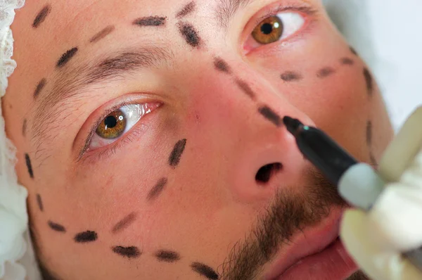 Closeup young mans face preparing for cosmetic surgery, getting lines drawn on skin with black marker, as seen from above