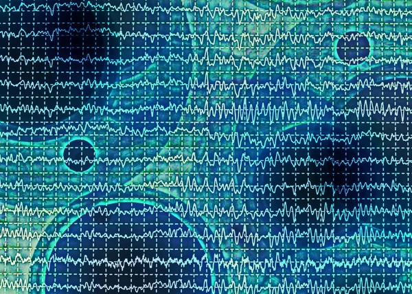 Brain wave on electroencephalogram EEG for epilepsy