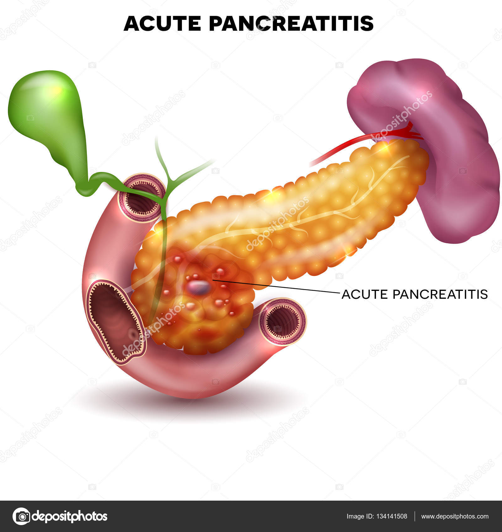 Ilustración de la Pancreatitis aguda — Vector de stock #134141508