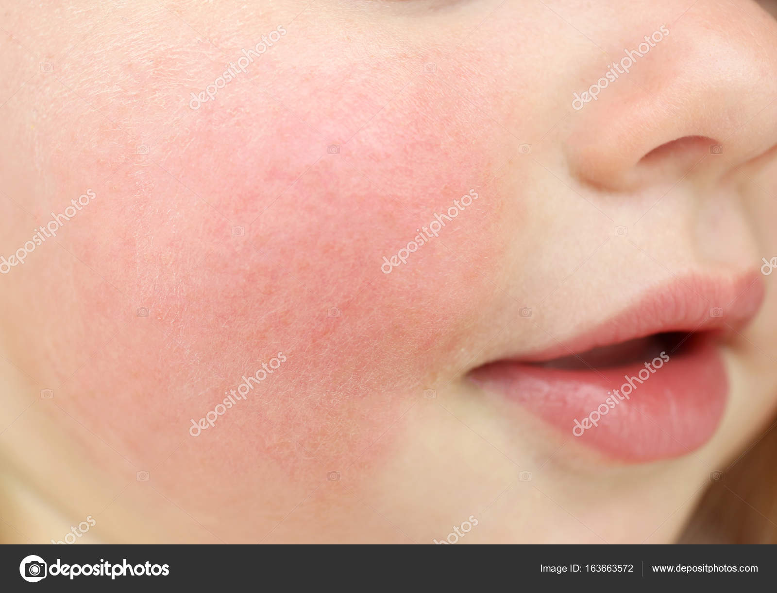 Атопический дерматит на щеках у ребенка