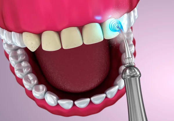 Teeth whitening , Medically accurate 3D illustration