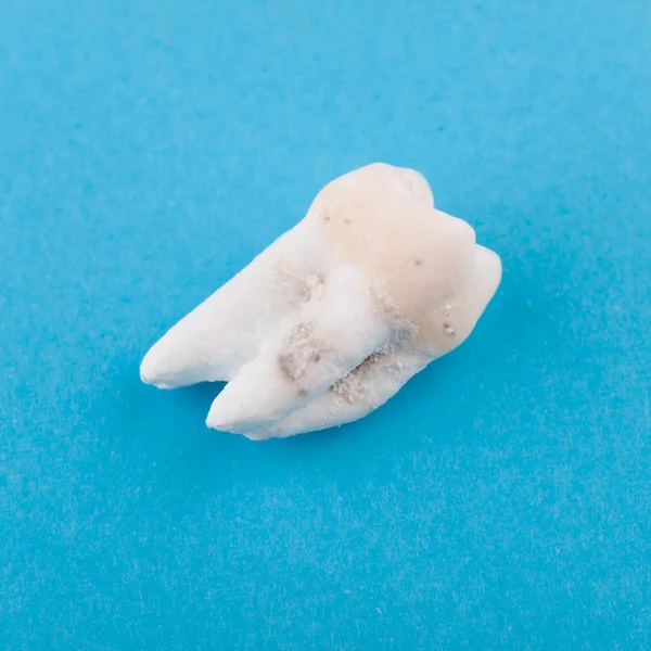 Top view of a single decayed wisdom tooth on a blue background