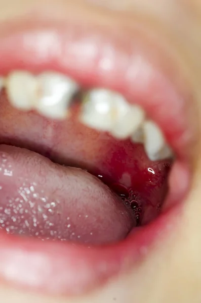Infection of ulcer inside mouth
