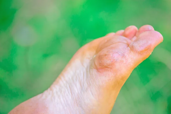 Dry dehydrated skin on the heels of female feet with calluses