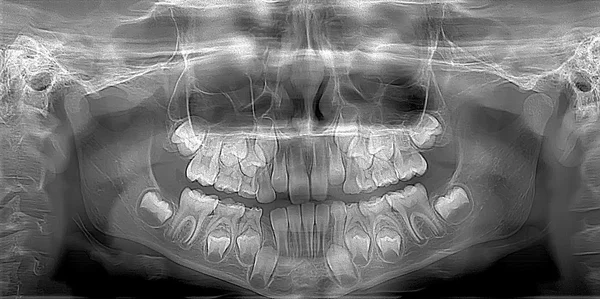 X-ray picture of the child jaw