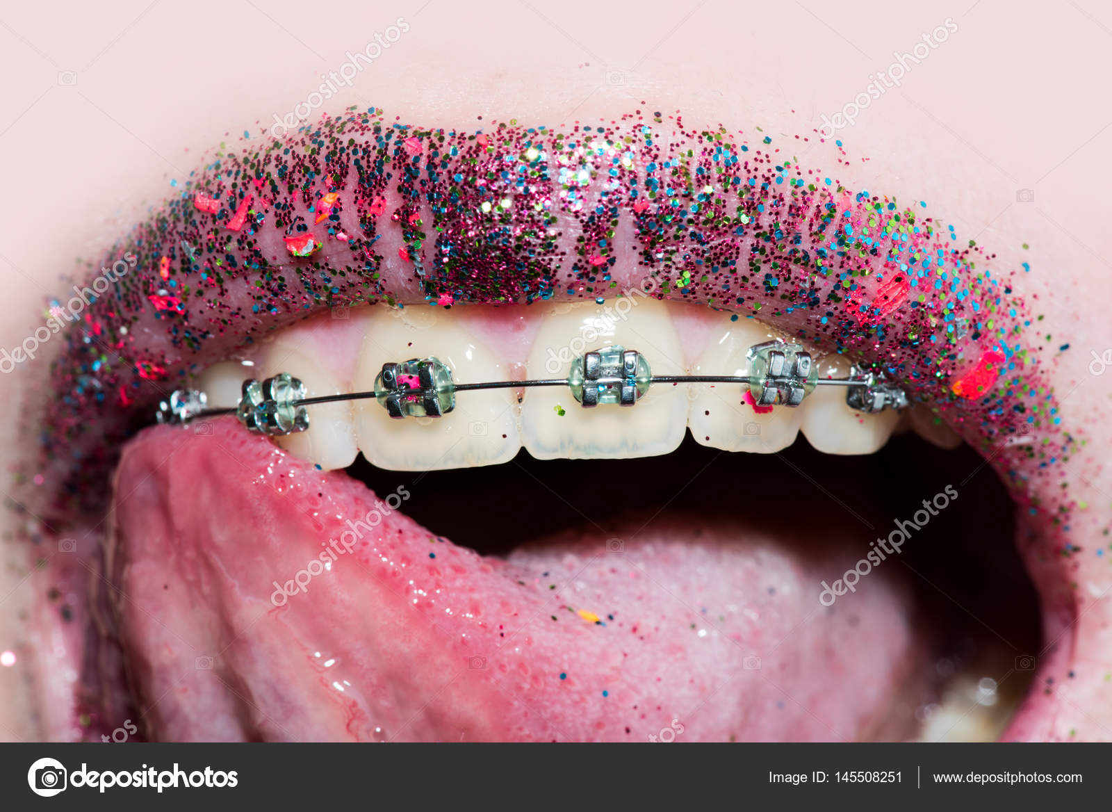 Dental braces on female teeth and luxury fashionable lipstick with