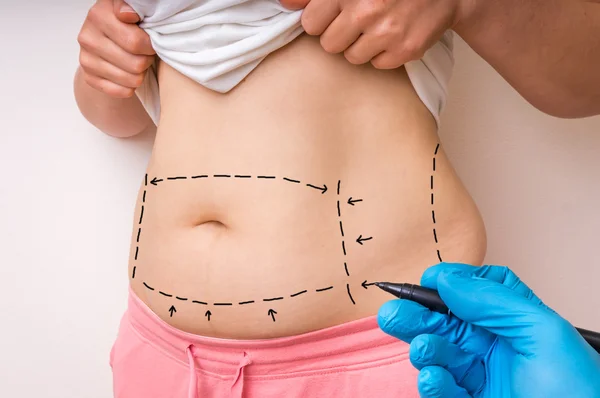 Plastic surgery doctor draw lines with marker on patient belly