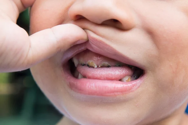 Asian boy smile with decayed teeth