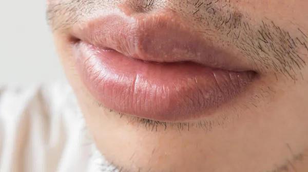 Closeup of lips man problem health care, Herpes simplex