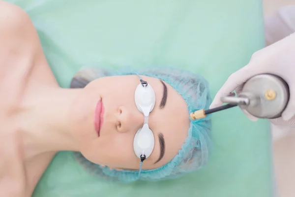 Liquid nitrogen cryotherapy procedure — Stock Photo, Image