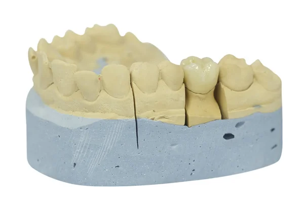Изображение Зубного Протеза Крупным Планом — стоковое фото
