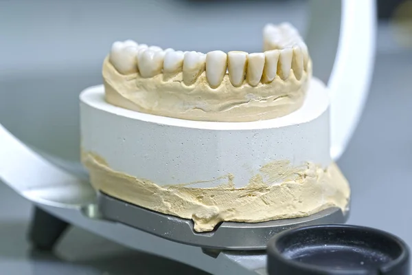 Изображение Зубного Протеза Крупным Планом — стоковое фото
