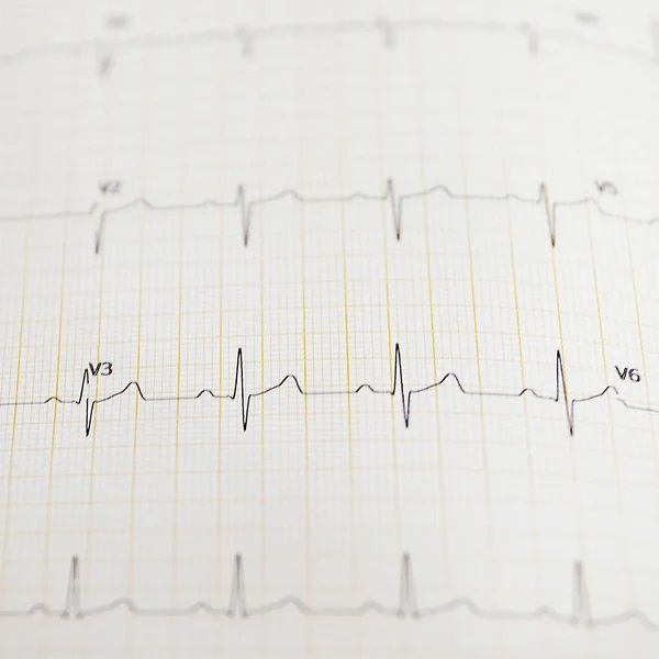 A imagem de um cardiograma — Fotografia de Stock