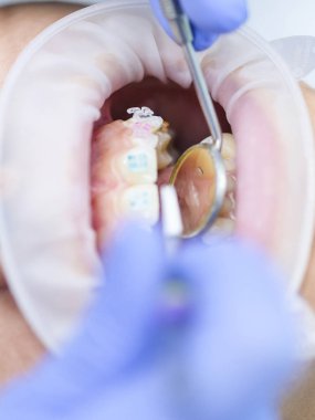 Ağız olan dişçi hastanın yakın çekim