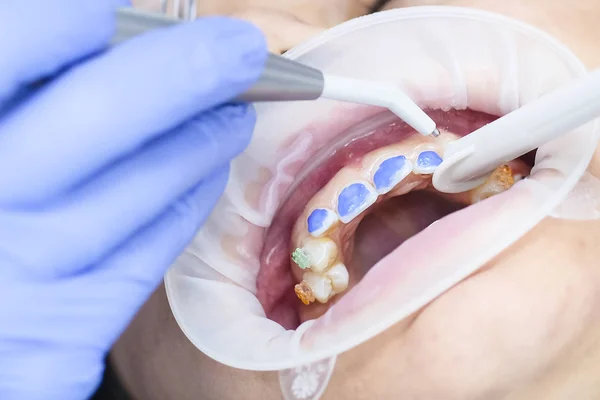 Bocca Del Paziente Del Dentista Vicino — Foto Stock