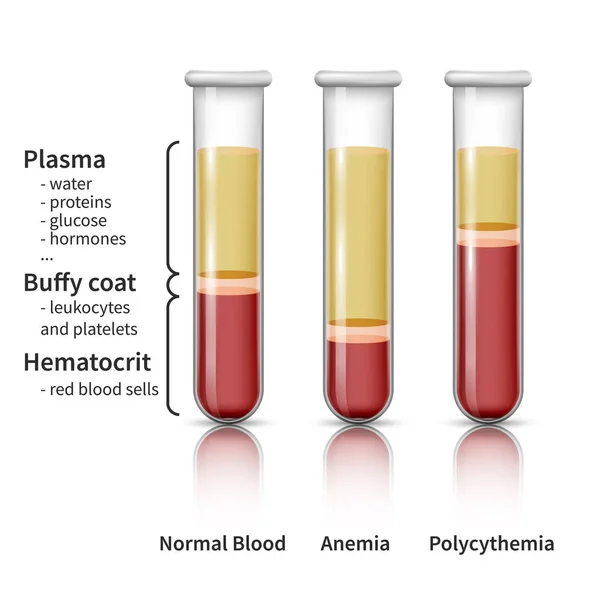 Infografías de análisis de sangre — Vector de stock