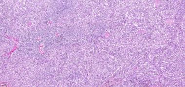 Santral arter dalak bir insan hiyalin dejenerasyonu