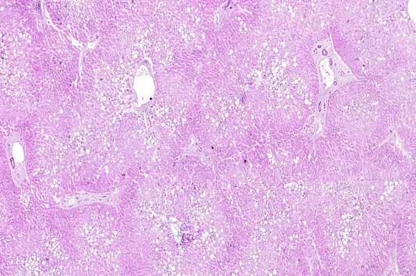 인간의 간 지방 변성 — 스톡 사진