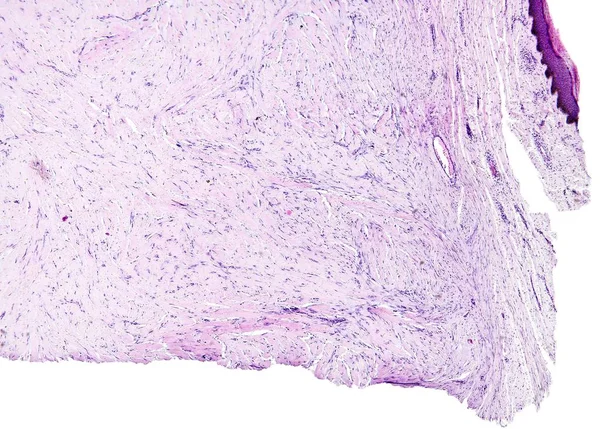 Connective tissue, hyaline degeneration of a human