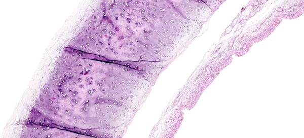 Histologia do tecido humano, mostrar traqueíte como visto ao microscópio — Fotografia de Stock