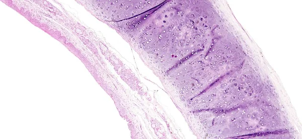 顕微鏡下で見られるように人間のティッシュの組織学が気管支粘膜の扁平上皮化生を表示します。 — ストック写真