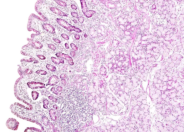 Histologie van menselijk weefsel, Toon maagslijmvlies intestinale metaplasie zoals gezien onder de Microscoop — Stockfoto