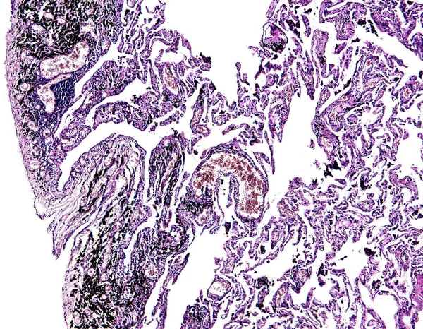 Histologia ludzkiej tkanki płuc Pokaż palenia widziana pod mikroskopem — Zdjęcie stockowe