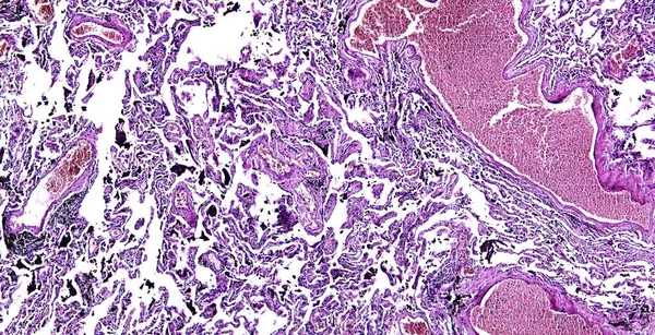 Istologia del tessuto umano, mostra congestione cronica del polmone come si vede al microscopio, zoom 10x — Foto Stock