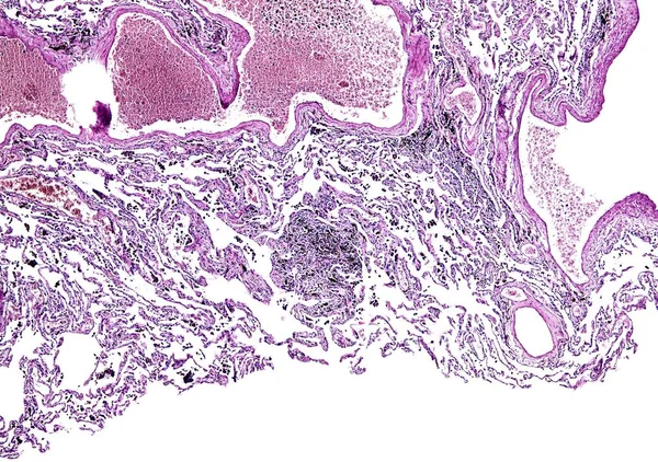 Histologia do tecido humano, mostram pulmão de fumar como visto sob o microscópio, zoom 10x — Fotografia de Stock