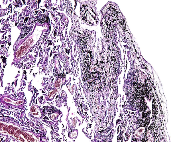 Istologia del tessuto umano, mostra il polmone del fumo visto al microscopio, zoom 10x — Foto Stock