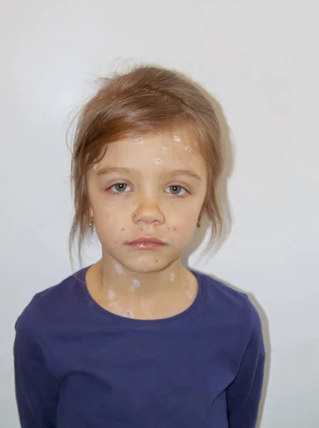 Varisella Virüsü Yüzünde Suçiçeği Kabarcıkları Olan Üzgün Küçük Bir Kız — Stok fotoğraf