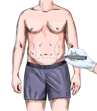 Erkek vücuduna plastik cerrahi çizim izleri.