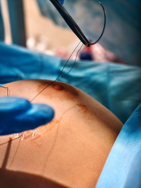 Meme büyütme kadın operasyonu. Doktor dikiş yara cerrahi iplik.