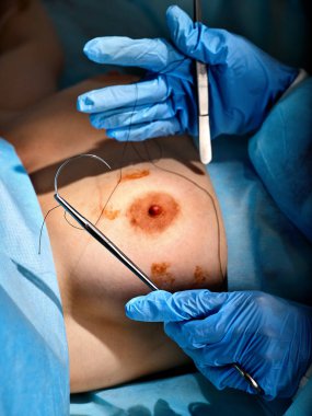 Plastik cerrahi vücut parçası için büyütme, meme implantları.