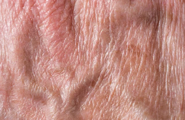 Age Spots Skin Stock Photos Royalty Free Images Depositphotos