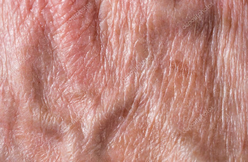 Age Spots Skin Stock Photos Royalty Free Images Depositphotos
