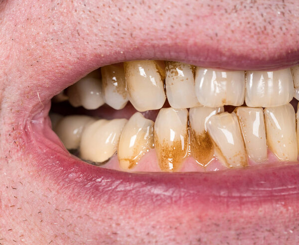 Close up of mouth with brown plaque stains