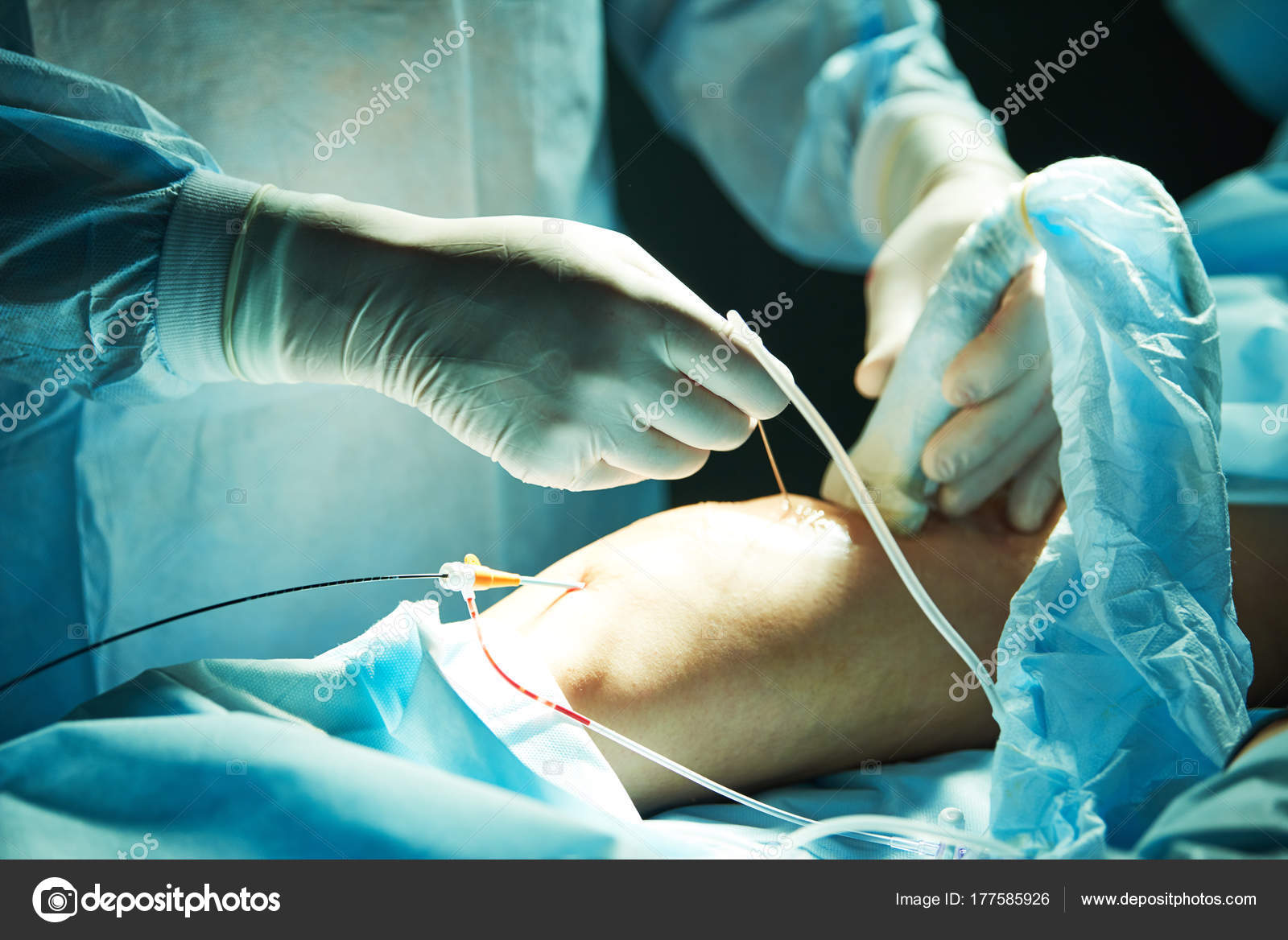 Operacion De Varices En Que Consiste Operacion De Varices En Que Consiste