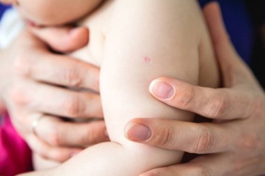 BCG vaccination mark is on infant shoulder, close-up view with mother hands clipart