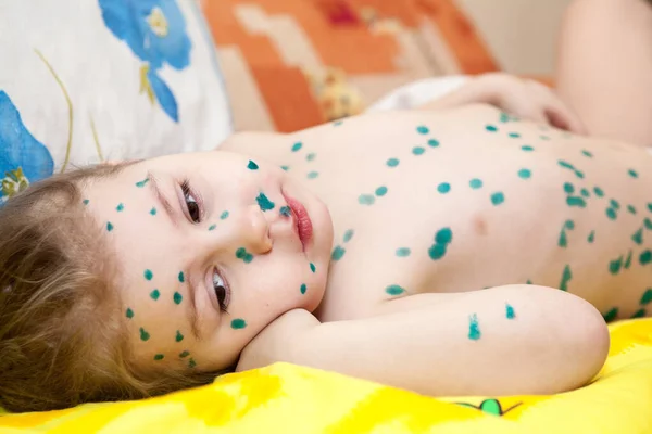 Portrait Cute Little Girl Sad Eyes Kid Lying Bed Chickenpox — Stock Photo, Image