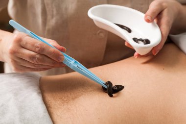 Doktor bir sülük koyar