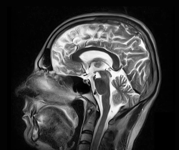 脳の磁気共鳴画像 — ストック写真