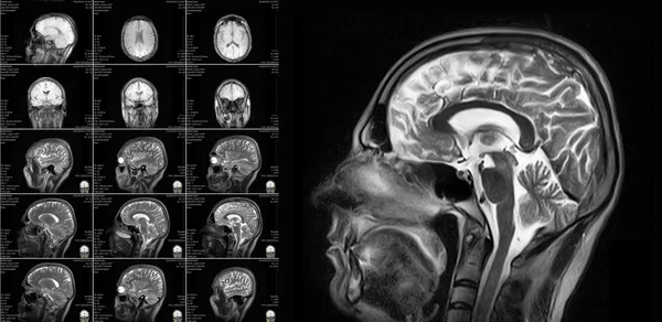 Magnetic resonance imaging of the brain — Stock Photo, Image