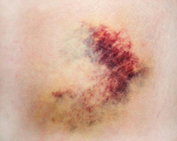 Bruise on skin — Stock Photo, Image
