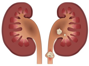 Nephrolithiasis böbrek taşı hastalığı