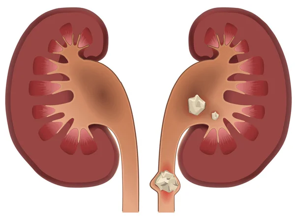 Nephrolithiasis böbrek taşı hastalığı
