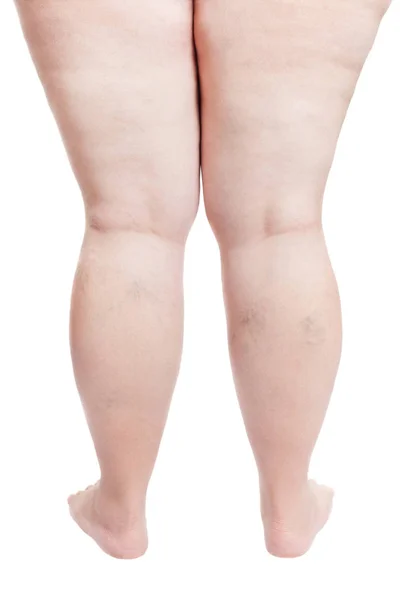 Benen van een dikke vrouw met spataderen (overgewicht, obesitas) Stockafbeelding