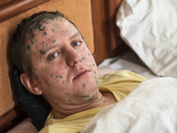 Homme atteint de varicelle — Photo