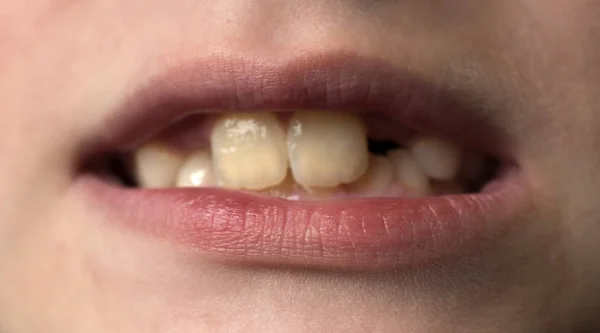 Boca con dientes de bebé — Foto de Stock