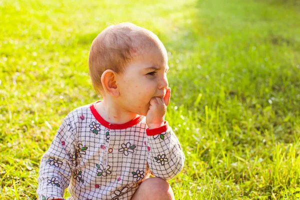 Bébé avec éruption de varicelle assis à l'herbe verte — Photo